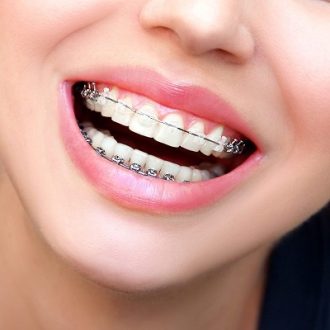 Are Ceramic Braces More Bulky in Dubai?