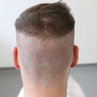 Discovering The Best Three Fue Hair Transplants