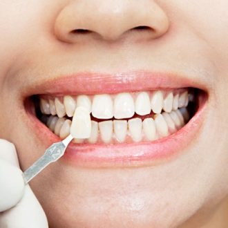 Does Plaque Grow On Veneers in Dubai?