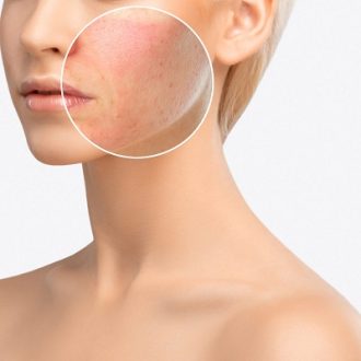 Is Laser Scar Removal Right For You in Dubai?