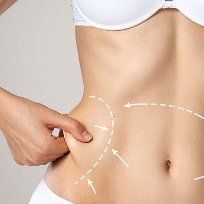 Liposuction: The Expectations, Risks, And Benefits