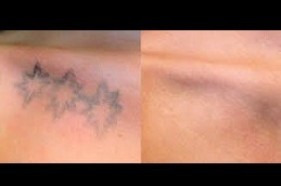 Safe And Efficient Laser Tattoo Removal in Dubai