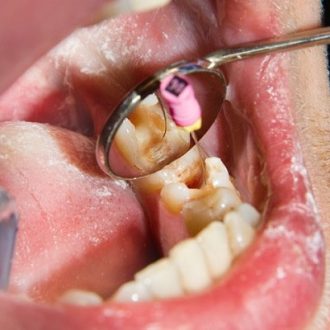The Difference Between Having A Cavity And Needing A Root Canal