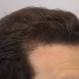 What Happens After A Hair Transplant Surgery?