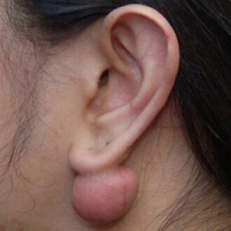 A Comprehensive Guide To Treating Hypertrophic Scars