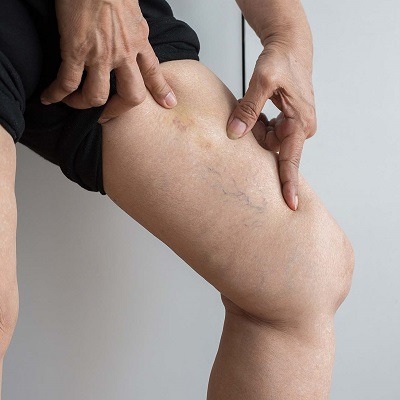 Are Spider Veins A Sign Of Bad Health in Dubai?