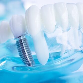 Can Dental Implants Be Covered In A Day?