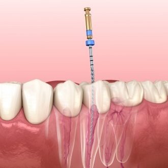 Do You Always Need A Crown After A Root Canal?