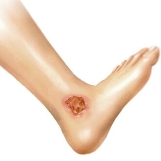 Effective Treatment Strategies For Chronic Wounds: A Comprehensive Guide