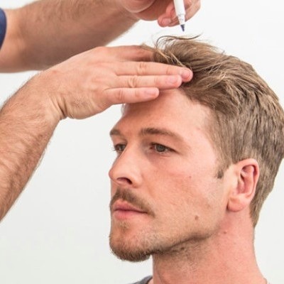 Factors To Consider For A Hair Loss in Dubai