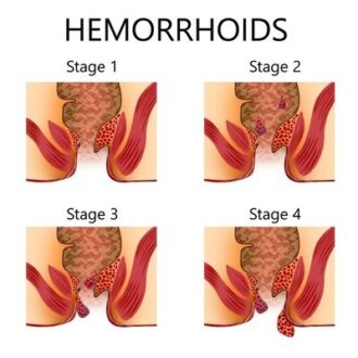 Female Doctor For Hemorrhoids In Dubai