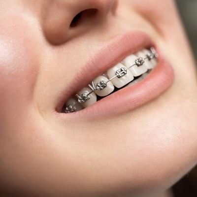 How Many Teeth Are Removed For Braces in Dubai & Abu Dhabi - Cost