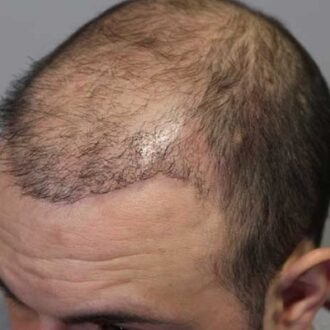 Maximum Grafts In DHI Hair Implant in Dubai