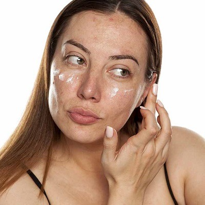Melasma Treatment Options - Dermatologist-Approved Solutions in Dubai