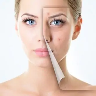 Pros And Cons Of Laser Scar Removal: Is It Right For You?