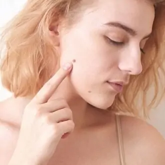 Saying Goodbye To Moles: Exploring Modern Removal Trends In Dubai