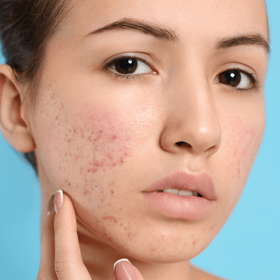The Subcision Solution: Minimize Acne Scars And Boost Confidence