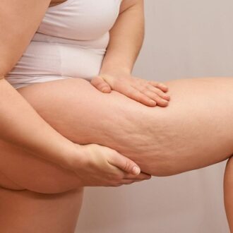 Understanding Cellulite: Causes And Factors