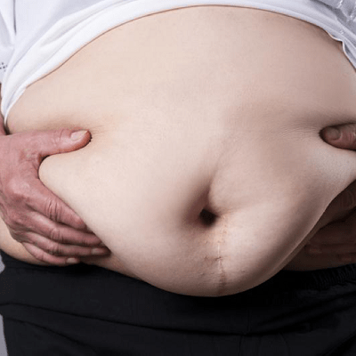 Can Stomach Grow After Bariatric Surgery in Dubai