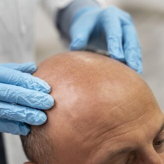 Exploring FUE Hair Transplant Techniques in Dubai