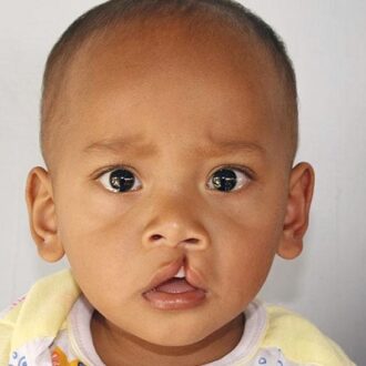 How Does Lip & Palate Surgery Work In Dubai