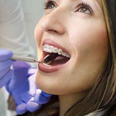 How To Find Affordable Dental Braces In Dubai