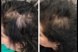 Mesotherapy Vs. PRP For Hair, Which Is Better dubai