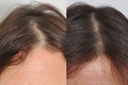 Mesotherapy Vs. PRP For best Hair, Which Is Better dubai