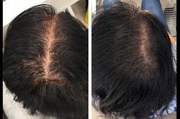 Mesotherapy Vs. PRP For best Hair, Which Is Better in dubai