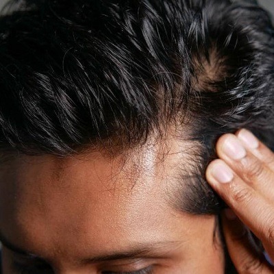 PRP Hair Restoration In Dubai & Abu Dhabi