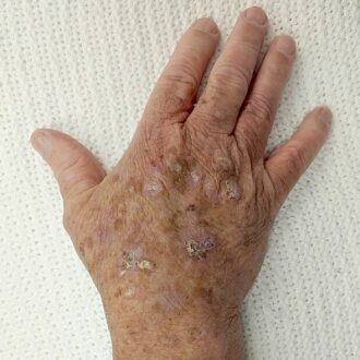 Quick Clear: Actinic Keratosis Rapid Result In Dubai