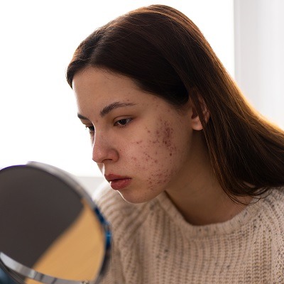 Reclaim Your Skin: Tried-And-True Pimple Treatments