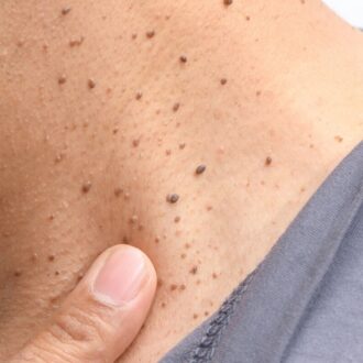 Smooth Skin Ahead: Seborrheic Keratosis Solutions