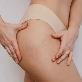 The Art Of Concealing: Scar Camouflage Techniques