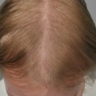 Unlocking The Secret: Exosomes And Hair Loss Solutions