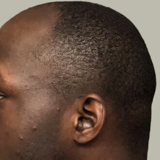 Best African-American Hair Transplant Surgeons