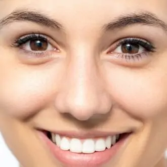 Crow’s Feet Botox Dubai & Abu Dhabi