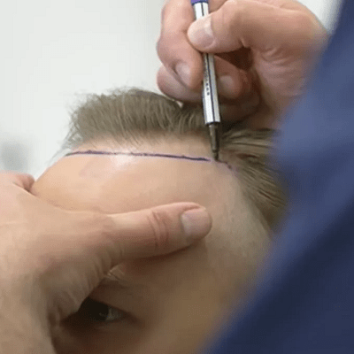 Complications of Hair Transplant Procedures