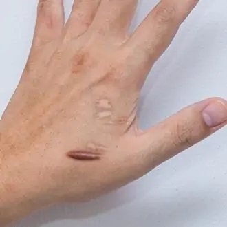 Keloid Treatment: A Step-By-Step Guide in Dubai