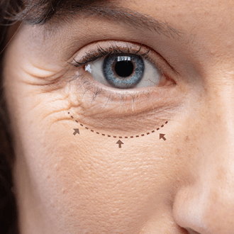 Lower Blepharoplasty Dubai & Abu Dhabi