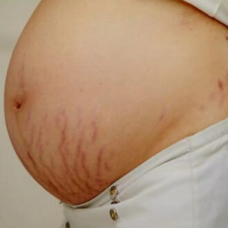 Purple Stretch Marks Treatment In Dubai