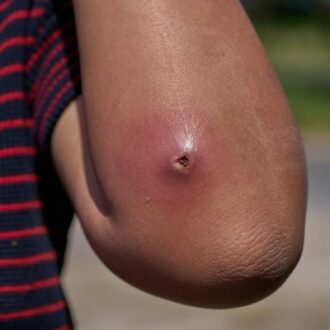 Slice And Relieve: The Art Of Abscess Drainage Explained