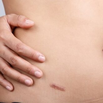 Surgical Scar Revision: What You Need To Know