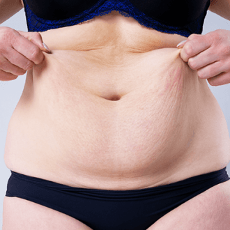 The Incredible Impact Of A Body Lift In Dubai