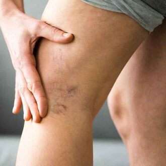 Varicose Veins Laser Therapy In Dubai & Abu Dhabi