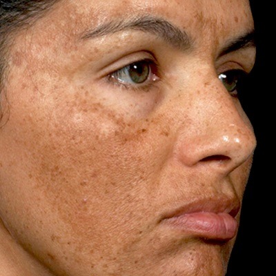 What Are The Long-Term Effects Of Melasma?