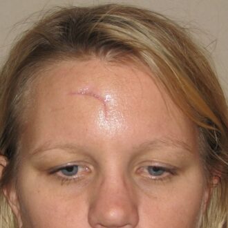 Why Is Facial Scar Revision Important in Dubai