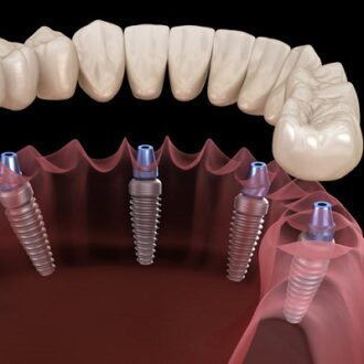 Benefits of Choosing Dental Implants Over Dentures