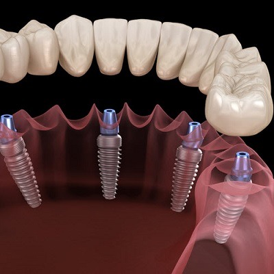 Benefits of Choosing Dental Implants Over Dentures in Dubai Cost