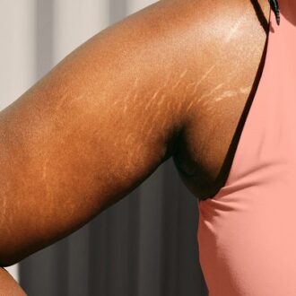 Choosing The Right Stretch Marks Treatment For Your Skin
